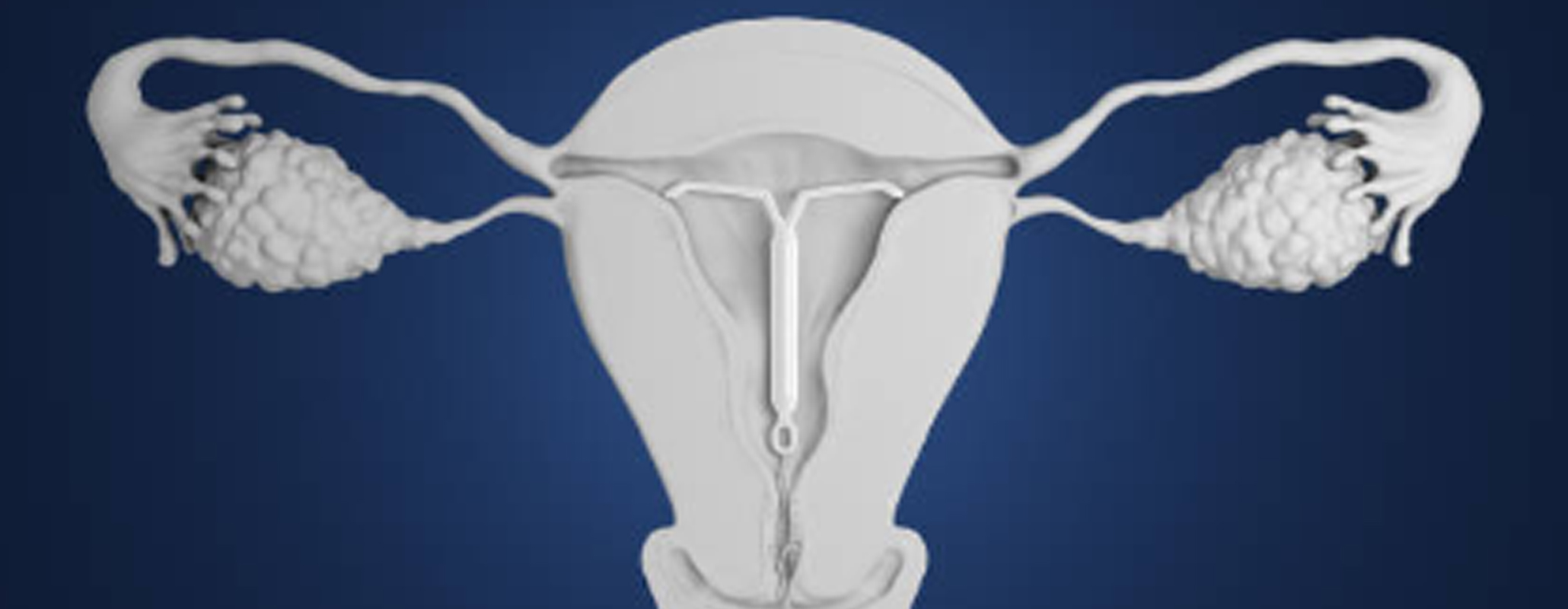 Dispositivos Intrauterinos Hormonales